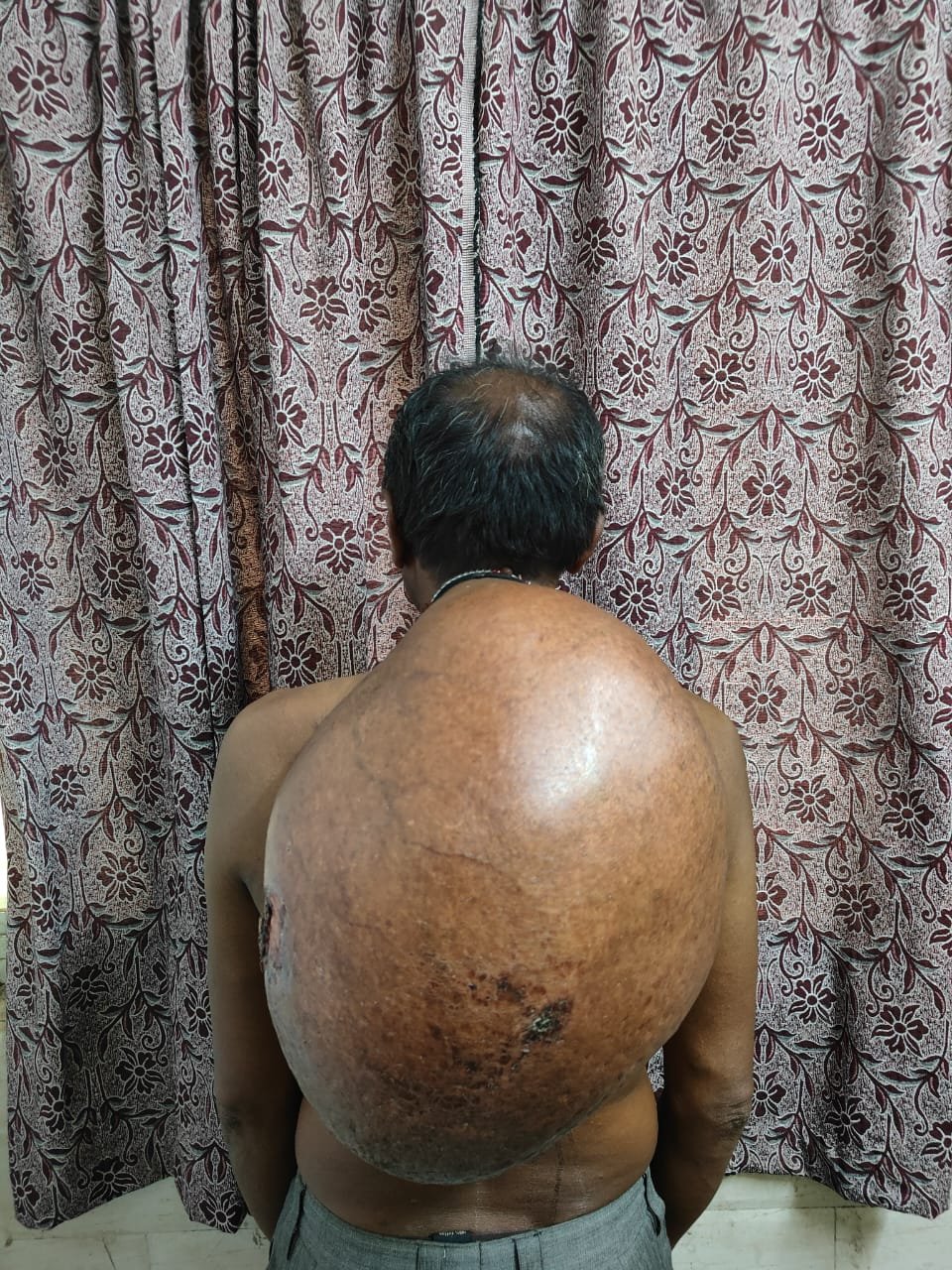 HEALTH; अम्बेडकर अस्पताल में ऐतिहासिक सर्जरी, 10.30 किलोग्राम वजनी ट्यूमर का ऑपरेशन, मरीज के पीठ का बोझ हटा